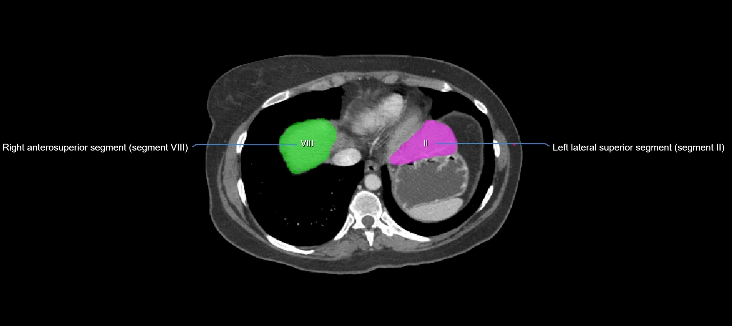 CT liver segments axial cross sectional anatomy labelled image-00073.webp